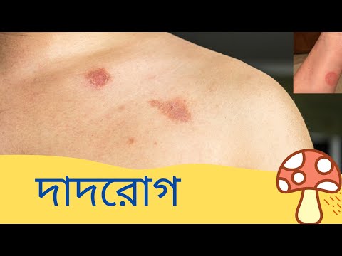 ভিডিও: কুকুরগুলিতে রিংওয়ার্ম - কারণ, লক্ষণ ও চিকিত্সা