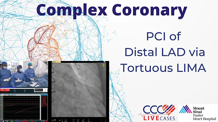 PCI of Distal LAD via Tortuous LIMA
