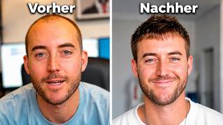 Meine Haartransplantation in der Türkei