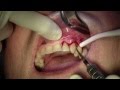 Alloderm Gingival Grafting, #11 Facial Site - Full Version