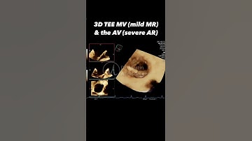 3D TEE mitral valve & AV - AV endocarditis