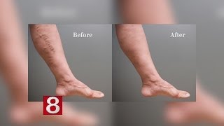 Removing Varicose Veins