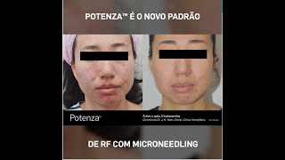 Potenza - Radiofrequência com microneedling com 4 modos