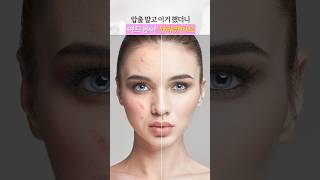 여드름 압출 말고 비비엘 했더니 피부가 깨끗해졌어요