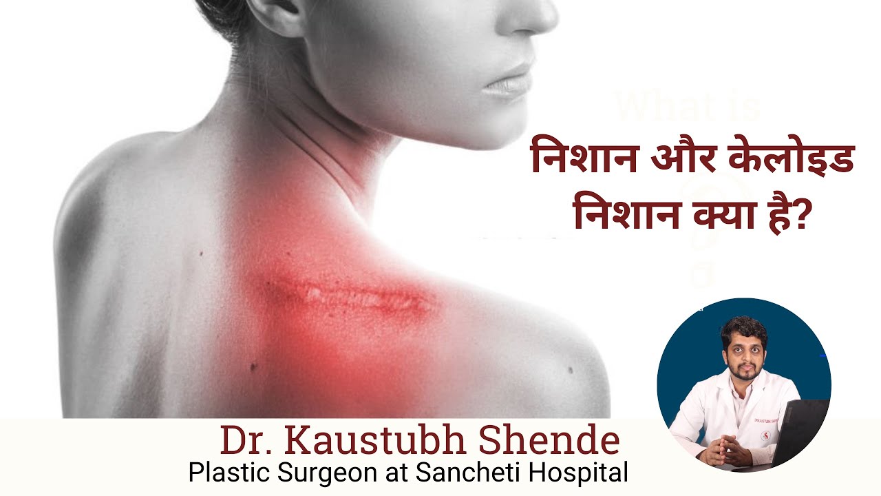 What are scars and keloid scars? Treatment options for Scars Dr