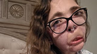 November 29, 2025 VLOG - 3 days before 30th surgery 