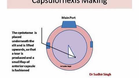 Animation ! Capsulorhexis Making