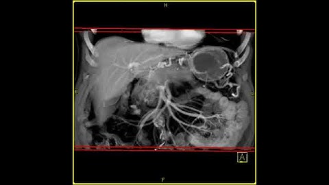 Abdomen: Pancreas: Pancreatic cancer : 3D mapping using volume rendering and MIP(1 of 2)