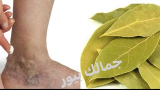 اقسمت بربها دهنه واحده قبل النوم خلصتها من دوالي الساقين والاوردره العنكبوتيه نهائيآ