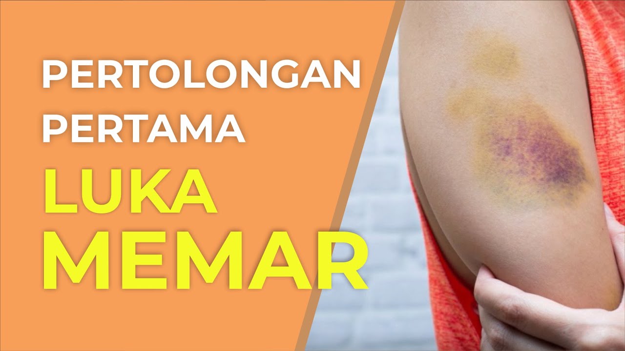 Cara Aman Mengatasi Memar Lebam First Aid Youtube<script async src=