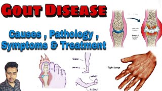 Gout Disease / Cause / Pathology / Symptoms / Treatment / Arthritis (Nursing Lecture in Hindi MSN 1)