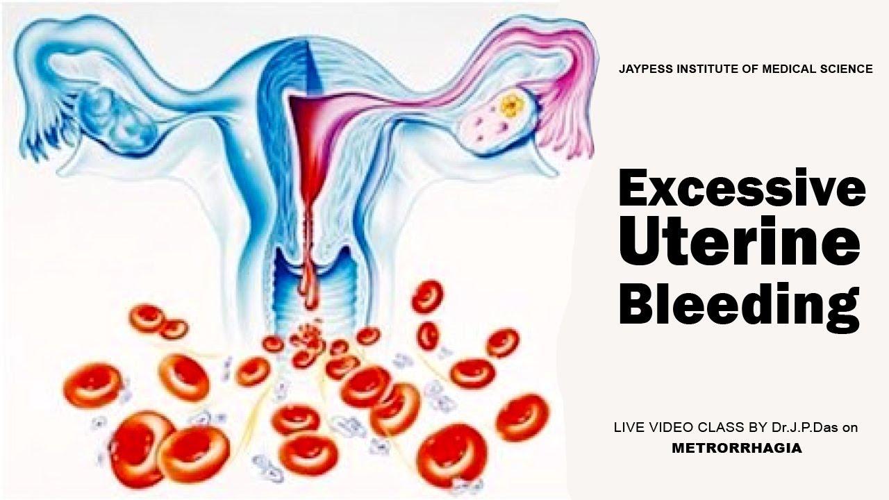 Обильные и болезненные. Кровотечение из половых путей. Патологические маточные кровотечения. Обильное маточное кровотечение.