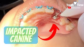 Impacted Canine Braces Treatment - 9 Months of Orthodontic Traction  - Tooth Time Family Dentistry