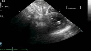 TTE Normal Subcostal Short Axis Pap Muscles Example 1