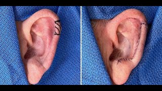 Ear reconstruction with an antia-buch flap