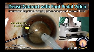 CataractCoach 1611: dense cataract with foot pedal video