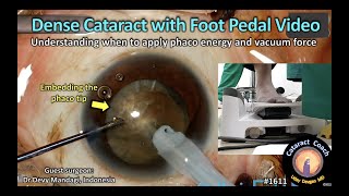 CataractCoach 1611: dense cataract with foot pedal video