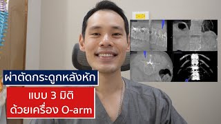 ผ่าตัดกระดูกสันหลังหัก แบบ 3 มิติ ด้วยเครื่อง O-arm | EasyDoc EP.44