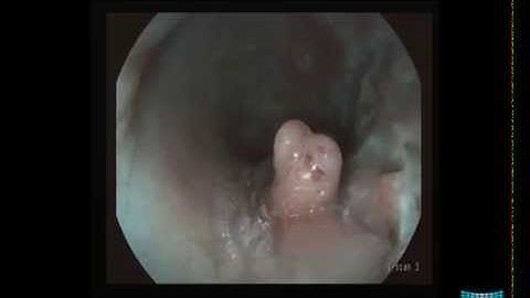 Endoscopic Findings in Crohn
