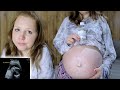 1 hour pregnancy glucose tolerance test! Gestational diabetes results &amp; macrosomia baby update