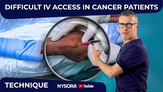 Difficult IV in Cancer Patients - Do not Depend on Ultrasound by NYSORA - Education 13,478 views 2 months ago 6 minutes, 10 seconds