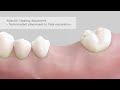 Atlantis Healing Abutment - from implant placement to final restoration_subtitles