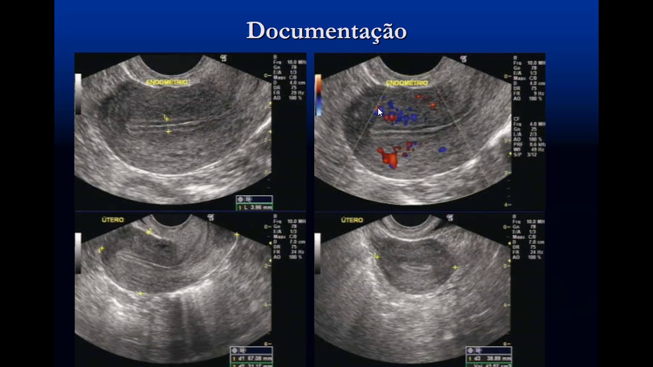 giardiaza ca la adulți esophageal papilloma treatment