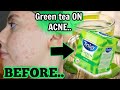 I TESTED A GREEN TEA BAG ON MY FACE FOR ONE WEEK FOR MY ACNE || THIS IS WHAT HAPPENED TO MY SKIN