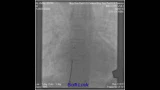 Al Amin 18 Y , 43 Kg ASD device closure