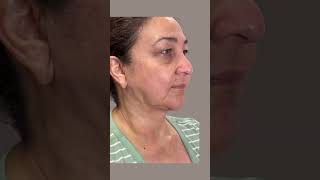 SUBMENTAL CONTOURING CHIN LIPO