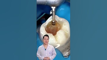 Xử Lý Lỗ Sâu Siêu To Khổng Lồ Cùng Bác Sĩ Cường Nào ! | |Dr Cường Offical | #bacsicuong #tramrang