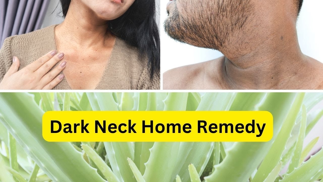 Dark Neck REMOVAL HOW TO GET RID OF DARK NECK DIY PIGMENTATION REMEDIES, 100 NATURAL & SAFE🌿