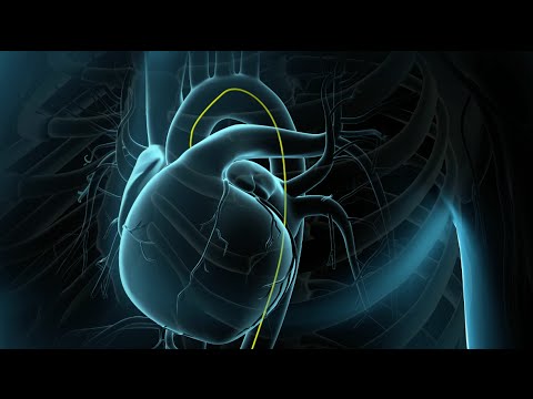 Vídeo: Angioplastia Da Artéria Periférica E Colocação De Stent