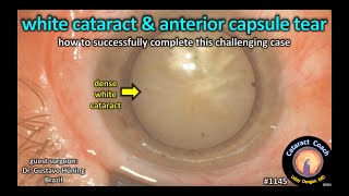 CataractCoach 1145: dense white cataract anterior capsule tear out