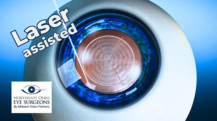 Discover the Advantages of Laser-Assisted Cataract Surgery at NEOES