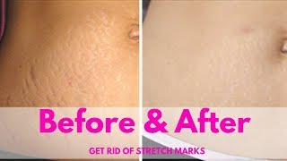 Get Rid of Stretch Marks FAST with this Essential Oils Stretch Marks Miracle Cure