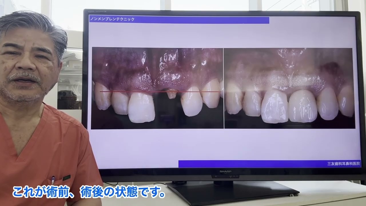 ノンメンブレンテクニックの利点を実例を見ながら、村辺先生が解説し