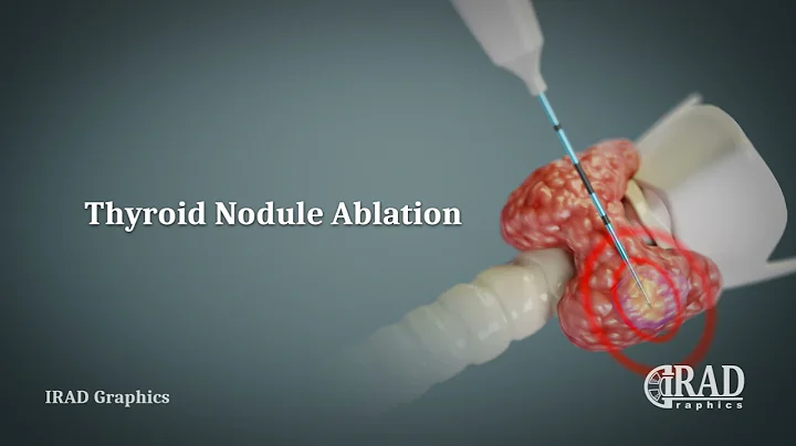 Thyroid Nodule Ablation