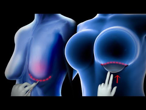 Video: Vad betyder skvalp i bröstimplantat?