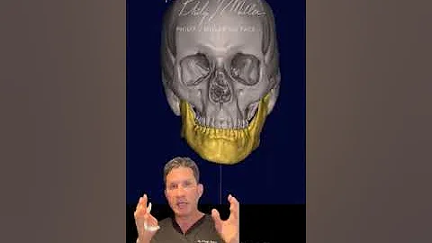 Customized Jaw Implant To Correct Asymmetrical Facial Feature | NYC Facial Plastic Surgery