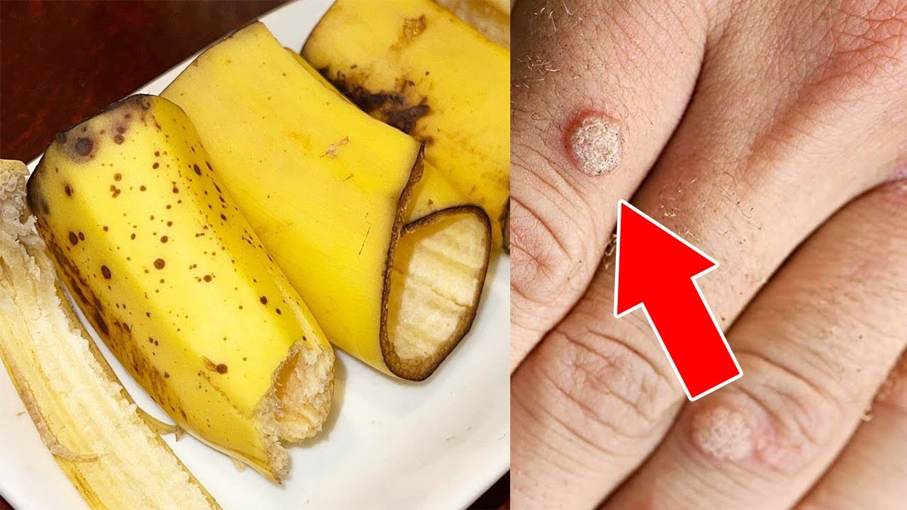 OVERNIGHT REMEDY| BANANA PEEL TO REMOVE WARTS - YouTube
