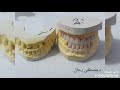 تركيبات زيركون للاسنان الامامية-تصحيح العضة المعكوسة zirconium crowns for anterior teeth-crossbite
