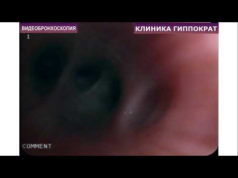 Как проводится бронхоскопия