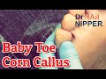 What is Corn Callus? On the Baby Toe? Dr Nail Nipper Explains How Happens [Callus Tuesday] (2021)