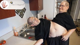 What happens if a conjoined twin dies? Unbelievable facts! ~ Body Bizarre