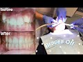 GETTING MY BRACES OFF! (satisfying)