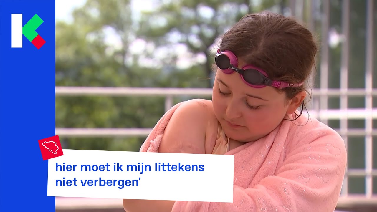 kinderen met brandwonden samen op kamp