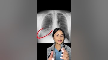 Chest X-Rays 🩻