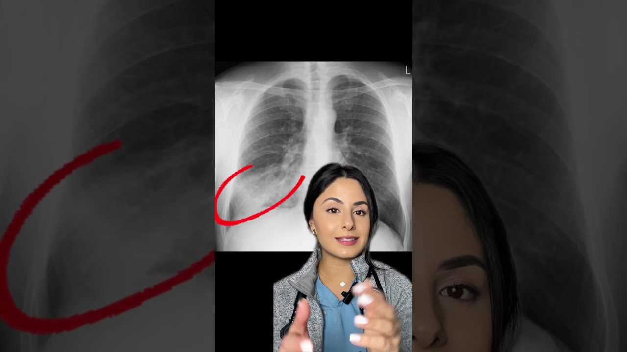 Chest X Rays 