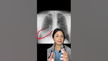 Chest X-Rays 🩻